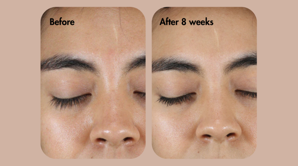 مقارنة قبل وبعد علاج الحاجب على وجه الشخص.
